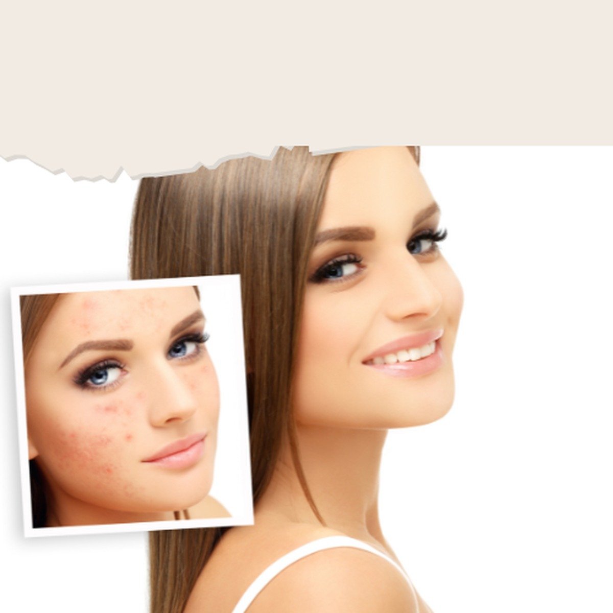Acnet de Sederma, activo en gel para piel grasa y con tendencia acneica — LTSH